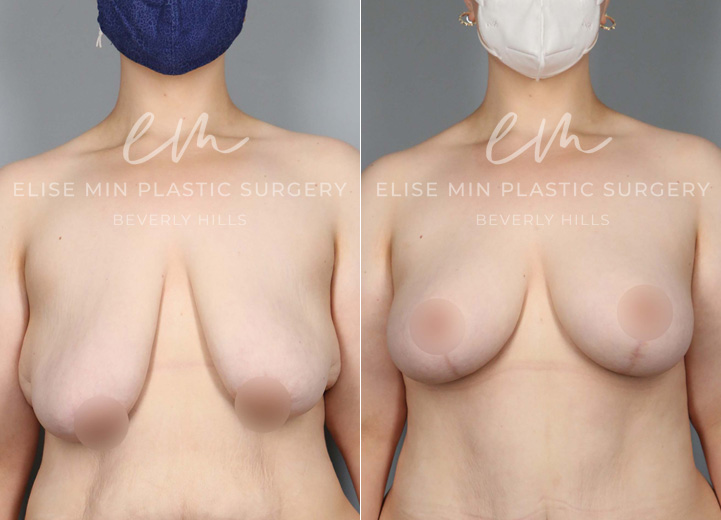 This remarkable 24-year-old patient lost 150 pounds over two years through a healthy diet and exercise. The successful weight loss led to excess skin that did not shrink back as she desired. She now desired perkier, fuller breasts but was not interested in having breast implants placed. Based on her anatomy and desires, a custom-tailored plan was made for her, and she underwent a breast lift using the auto-augmentation mastopexy technique. This method allowed the excess skin and tissue along the side of her chest below her armpit area to be rotated into her breast tissue to give extra perk and volume. This is a great technique, particularly for massive weight loss patients who frequently have excess skin and tissue to the side of their breasts. In one area, it may be undesirable, saggy tissue, but in another, it can be the key to extra perky volume!