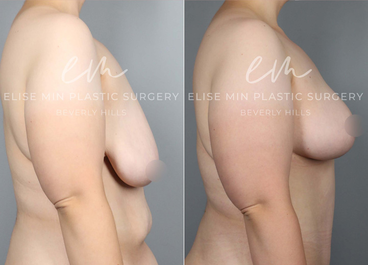 This remarkable 24-year-old patient lost 150 pounds over two years through a healthy diet and exercise. The successful weight loss led to excess skin that did not shrink back as she desired. She now desired perkier, fuller breasts but was not interested in having breast implants placed. Based on her anatomy and desires, a custom-tailored plan was made for her, and she underwent a breast lift using the auto-augmentation mastopexy technique. This method allowed the excess skin and tissue along the side of her chest below her armpit area to be rotated into her breast tissue to give extra perk and volume. This is a great technique, particularly for massive weight loss patients who frequently have excess skin and tissue to the side of their breasts. In one area, it may be undesirable, saggy tissue, but in another, it can be the key to extra perky volume!