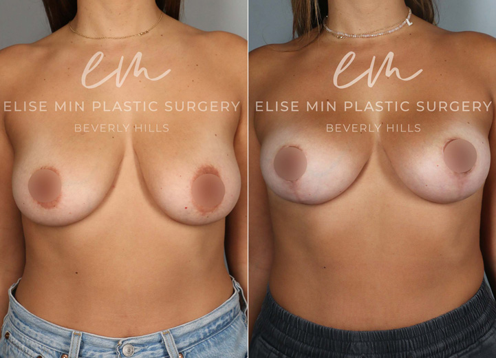 This lovely 35-year-old patient noticed flattening and sagging of her breasts after having children. She didn’t want larger breasts but desired a perkier, more youthful shape. To achieve this, she underwent a lollipop breast lift using a minimal incision technique. Due to her thin skin, a synthetic absorbable mesh was placed to support the lower pole of her breasts, helping to maintain long-term results.