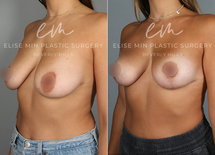 This lovely 35-year-old patient noticed flattening and sagging of her breasts after having children. She didn’t want larger breasts but desired a perkier, more youthful shape. To achieve this, she underwent a lollipop breast lift using a minimal incision technique. Due to her thin skin, a synthetic absorbable mesh was placed to support the lower pole of her breasts, helping to maintain long-term results.