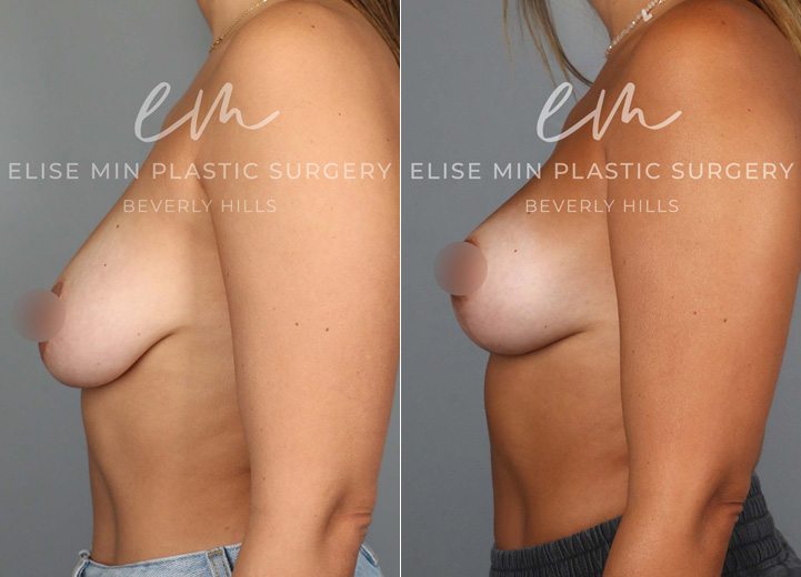 This lovely 35-year-old patient noticed flattening and sagging of her breasts after having children. She didn’t want larger breasts but desired a perkier, more youthful shape. To achieve this, she underwent a lollipop breast lift using a minimal incision technique. Due to her thin skin, a synthetic absorbable mesh was placed to support the lower pole of her breasts, helping to maintain long-term results.