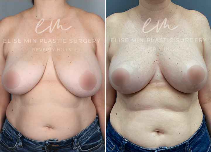 This 44-year-old patient experienced neck and upper back tension and wanted perkier, more symmetrical breasts. She underwent a bilateral mastopexy, with more tissue removed from the left breast to correct her natural asymmetry. While excess skin was removed from both breasts, the rearrangement of tissue during the lift created a beautifully enhanced shape, giving the appearance of added fullness without implants.