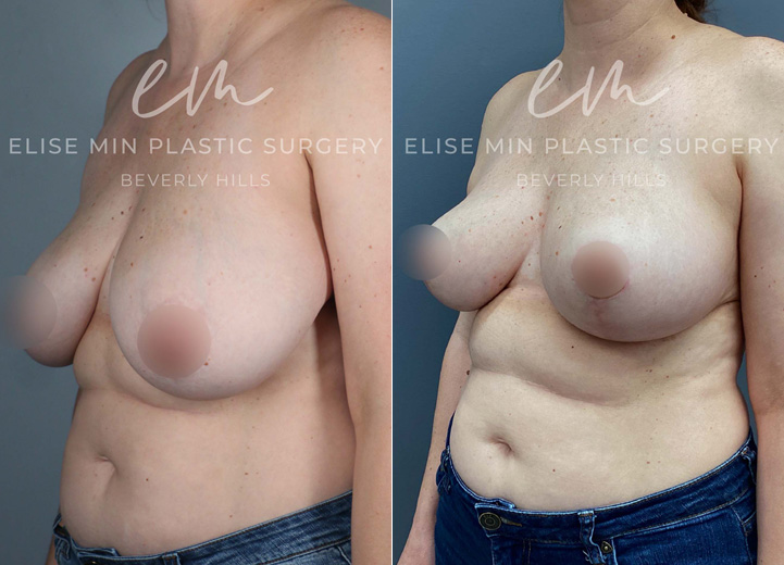 This 44-year-old patient experienced neck and upper back tension and wanted perkier, more symmetrical breasts. She underwent a bilateral mastopexy, with more tissue removed from the left breast to correct her natural asymmetry. While excess skin was removed from both breasts, the rearrangement of tissue during the lift created a beautifully enhanced shape, giving the appearance of added fullness without implants.