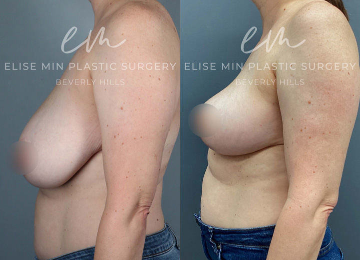 This 44-year-old patient experienced neck and upper back tension and wanted perkier, more symmetrical breasts. She underwent a bilateral mastopexy, with more tissue removed from the left breast to correct her natural asymmetry. While excess skin was removed from both breasts, the rearrangement of tissue during the lift created a beautifully enhanced shape, giving the appearance of added fullness without implants.