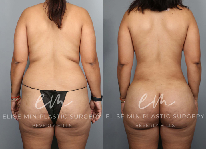 This is an energetic 43-year-old mom who felt that the stubborn fat around her abdomen and torso was impossible to lose, no matter how much she tried to exercise and diet. She initially thought liposuction of the abdomen was what she wanted. After our discussion, it was clear that the patient wanted to feel confident about her body, and in order to achieve her desired look, she needed 3-dimensional body liposuction and gentle fat transfer to the hip dips on both sides to create natural, feminine curves. She and her husband have now booked many beach trips ahead to show off her new look!