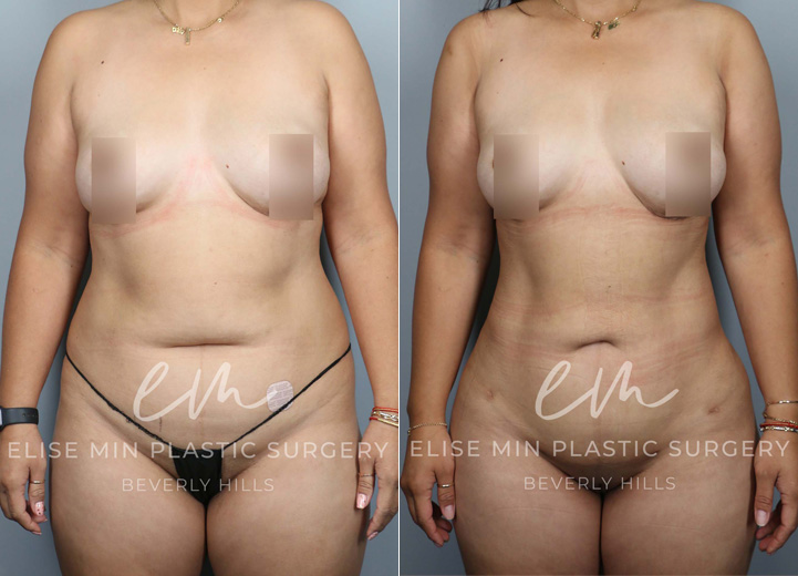 This is an energetic 43-year-old mom who felt that the stubborn fat around her abdomen and torso was impossible to lose, no matter how much she tried to exercise and diet. She initially thought liposuction of the abdomen was what she wanted. After our discussion, it was clear that the patient wanted to feel confident about her body, and in order to achieve her desired look, she needed 3-dimensional body liposuction and gentle fat transfer to the hip dips on both sides to create natural, feminine curves. She and her husband have now booked many beach trips ahead to show off her new look!