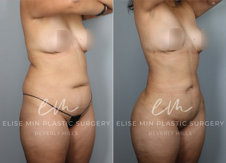 This is an energetic 43-year-old mom who felt that the stubborn fat around her abdomen and torso was impossible to lose, no matter how much she tried to exercise and diet. She initially thought liposuction of the abdomen was what she wanted. After our discussion, it was clear that the patient wanted to feel confident about her body, and in order to achieve her desired look, she needed 3-dimensional body liposuction and gentle fat transfer to the hip dips on both sides to create natural, feminine curves. She and her husband have now booked many beach trips ahead to show off her new look!