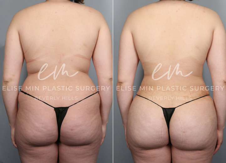 This lovely 21-year-old woman underwent liposuction of her abdomen, flanks and back along with gentle fat transfer to her hip dips and her buttocks. The goal was not to increase her buttock size since she was quite satisfied with her natural buttocks. The combination of both liposuction and gentle fat transfer was to create a balanced shape of her torso that accentuates her natural, feminine curve. She had to buy a whole new wardrobe after the procedure but she was absolutely thrilled to be doing so.