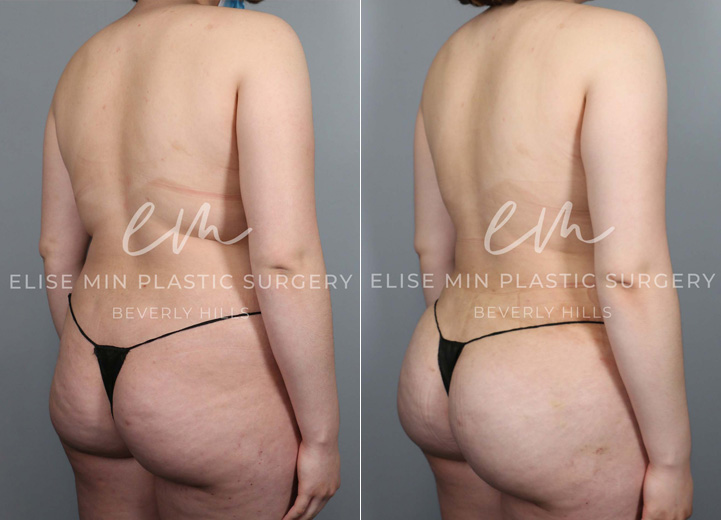 This lovely 21-year-old woman underwent liposuction of her abdomen, flanks and back along with gentle fat transfer to her hip dips and her buttocks. The goal was not to increase her buttock size since she was quite satisfied with her natural buttocks. The combination of both liposuction and gentle fat transfer was to create a balanced shape of her torso that accentuates her natural, feminine curve. She had to buy a whole new wardrobe after the procedure but she was absolutely thrilled to be doing so.