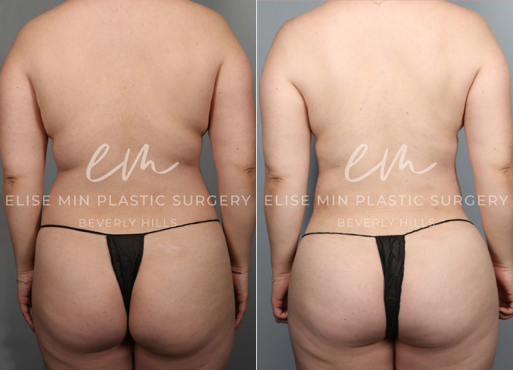 This is a 35-year-old woman with a busy work schedule, splitting her time between two cities. Her focus on work over the years has made it difficult for her to lose weight, and even when she was able to, she always carried persistent fat in her torso. She underwent liposuction of her abdomen, back, and flanks, and had gentle fat transfer to her hip dips and buttocks to reveal the natural, beautiful curve she had hidden. Going back to work, she felt more confident than ever.