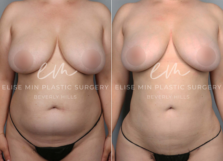 This is a 35-year-old woman with a busy work schedule, splitting her time between two cities. Her focus on work over the years has made it difficult for her to lose weight, and even when she was able to, she always carried persistent fat in her torso. She underwent liposuction of her abdomen, back, and flanks, and had gentle fat transfer to her hip dips and buttocks to reveal the natural, beautiful curve she had hidden. Going back to work, she felt more confident than ever.