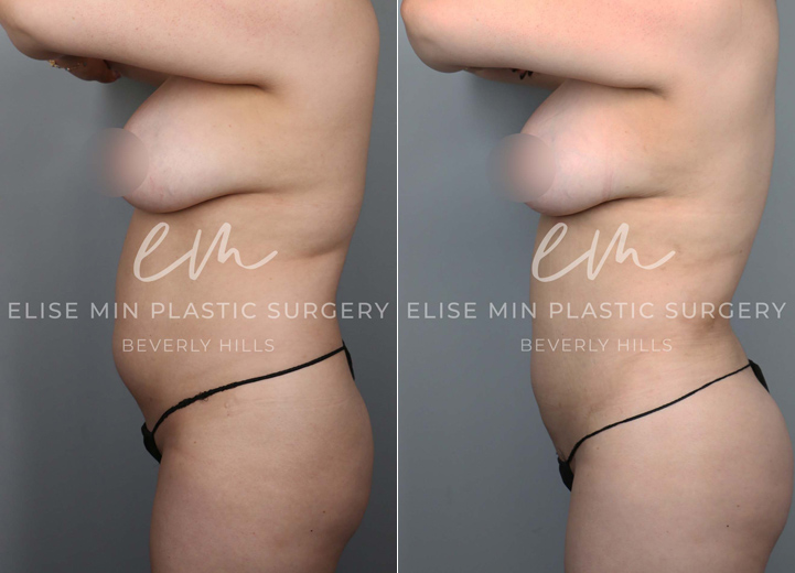 This is a 35-year-old woman with a busy work schedule, splitting her time between two cities. Her focus on work over the years has made it difficult for her to lose weight, and even when she was able to, she always carried persistent fat in her torso. She underwent liposuction of her abdomen, back, and flanks, and had gentle fat transfer to her hip dips and buttocks to reveal the natural, beautiful curve she had hidden. Going back to work, she felt more confident than ever.