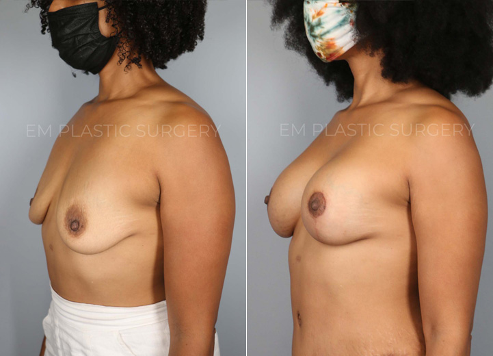This 39 year-old woman had two children that changed her breasts from being perky to very
deflated over the years. She was always a 34A cup and wanted to be a fuller C cup. She
underwent a breast lift procedure along with a silicone breast implant placement to help
restore both volume and shape. Her implants are Sientra smooth round moderate plus 305
implants. After the procedure, she got her confidence back and felt great in her clothes.