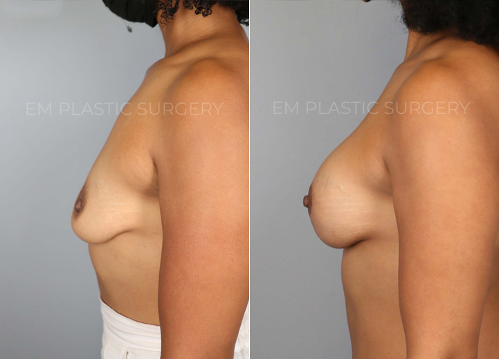 This 39 year-old woman had two children that changed her breasts from being perky to very
deflated over the years. She was always a 34A cup and wanted to be a fuller C cup. She
underwent a breast lift procedure along with a silicone breast implant placement to help
restore both volume and shape. Her implants are Sientra smooth round moderate plus 305
implants. After the procedure, she got her confidence back and felt great in her clothes.