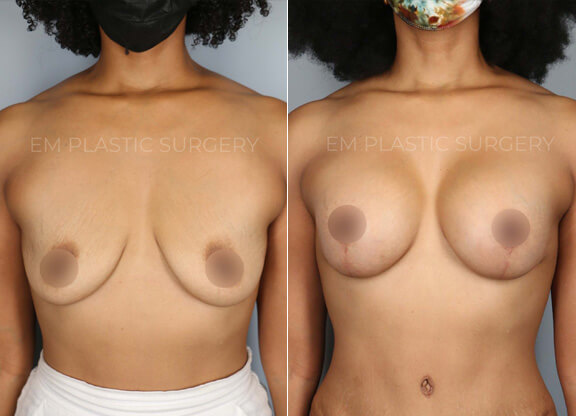 Breast Augmentation Surgery Before & After