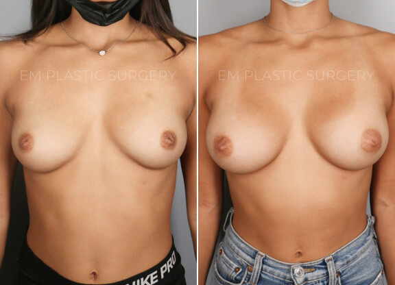 Breast Augmentation Surgery Before & After