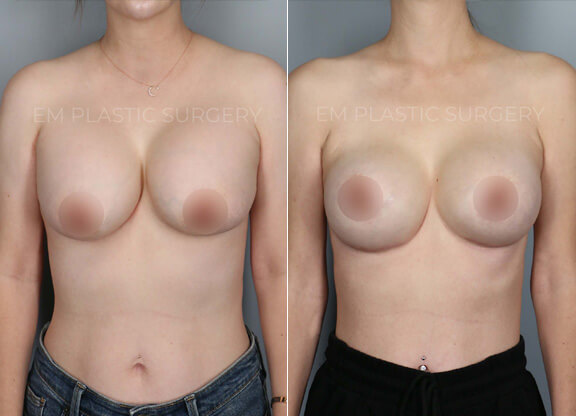 Breast implant Surgery Before & After