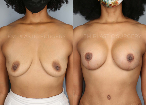 Breast lift Surgery Before & After