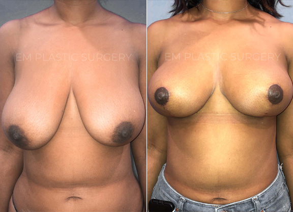 Breast lift Surgery Before & After
