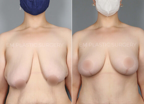 Breast lift Surgery Before & After