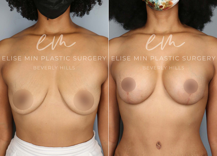 This 39 year-old woman had two children that changed her breasts from being perky to very deflated over the years. She was always a 34A cup and wanted to be a fuller C cup. She underwent a breast lift procedure along with a silicone breast implant placement to help restore both volume and shape. Her implants are Sientra smooth round moderate plus 305 implants. After the procedure, she got her confidence back and felt great in her clothes.