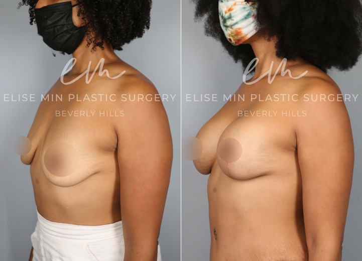 This 39 year-old woman had two children that changed her breasts from being perky to very deflated over the years. She was always a 34A cup and wanted to be a fuller C cup. She underwent a breast lift procedure along with a silicone breast implant placement to help restore both volume and shape. Her implants are Sientra smooth round moderate plus 305 implants. After the procedure, she got her confidence back and felt great in her clothes.
