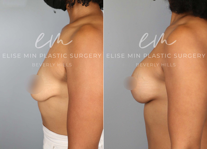 This 39 year-old woman had two children that changed her breasts from being perky to very deflated over the years. She was always a 34A cup and wanted to be a fuller C cup. She underwent a breast lift procedure along with a silicone breast implant placement to help restore both volume and shape. Her implants are Sientra smooth round moderate plus 305 implants. After the procedure, she got her confidence back and felt great in her clothes.