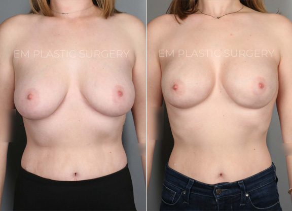 Breast Reconstruction Surgery Before & After