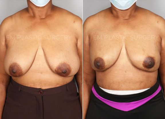 Breast Reconstruction Surgery Before & After