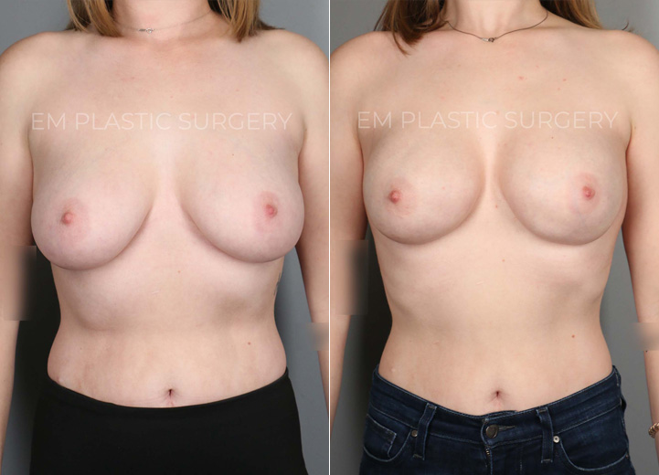 With an extensive family history of breast cancer and a genetic test confirming her increased risk of breast cancer,  this 29-year-old patient underwent a prophylactic nipple-sparing mastectomy and received an immediate breast reconstruction at the same time with Sientra moderate plus 415cc silicone breast implants above the pectoralis muscle. Her preoperative breast size was 32DD, and she wanted to stay similar in size. She healed beautifully from the procedure along with the relief that her future risk of breast cancer is significantly lower.