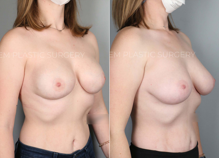 With an extensive family history of breast cancer and a genetic test confirming her increased risk of breast cancer,  this 29-year-old patient underwent a prophylactic nipple-sparing mastectomy and received an immediate breast reconstruction at the same time with Sientra moderate plus 415cc silicone breast implants above the pectoralis muscle. Her preoperative breast size was 32DD, and she wanted to stay similar in size. She healed beautifully from the procedure along with the relief that her future risk of breast cancer is significantly lower.