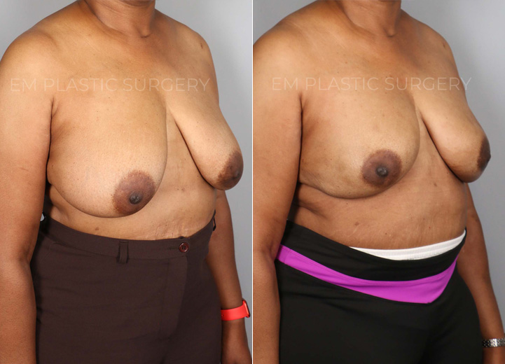 This is a 57-year-old nurse who was found to have multiple cysts and atypical breast lesions in the context of a significant family history of breast cancer. After discussing her case with her breast surgeon, she decided to pursue a prophylactic nipple-sparing mastectomy to reduce her future chance of breast cancer. From the reconstruction standpoint, she desired breasts that looked similar to her natural breasts. After her breast tissues were removed by the breast surgeon, she had Allergen moderate profile 600cc implants placed above the chest muscle with acellular dermal matrix mesh coverage. She was thrilled to have the results that made her feel as if she still had her natural breasts but with a lower risk of future breast cancer.