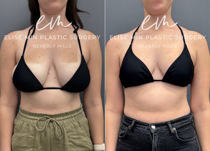 This 27-year-old woman felt her DDD breasts were overly heavy and lacked the lift she desired. She underwent a vertical scar breast reduction with 335g removed from one breast and 330g from the other. She is now a balanced, lifted C cup and very pleased with her results.