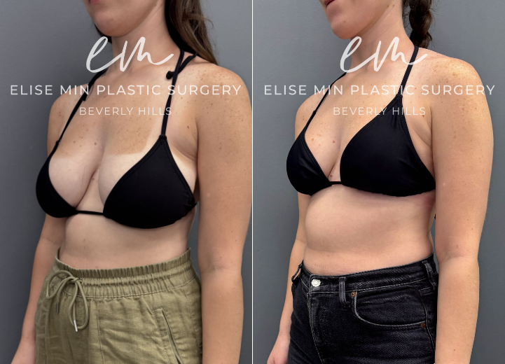 This 27-year-old woman felt her DDD breasts were overly heavy and lacked the lift she desired. She underwent a vertical scar breast reduction with 335g removed from one breast and 330g from the other. She is now a balanced, lifted C cup and very pleased with her results.