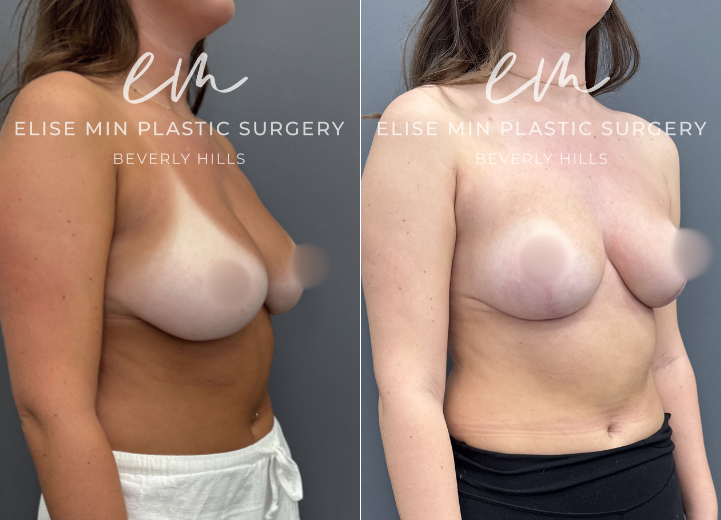 This 21-year-old woman with 32DD breasts felt that no bra ever fit her properly. Although she was unsure whether 32DD was her true size, she knew she wanted to be smaller and more proportionate to her frame. She underwent a modified vertical L-scar breast reduction with 191g removed from the left breast and 219g from the right. She is thrilled with her new C-cup size and loves being able to wear virtually any top with comfort and confidence.