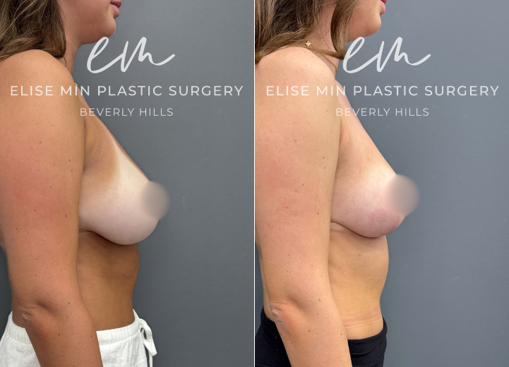 This 21-year-old woman with 32DD breasts felt that no bra ever fit her properly. Although she was unsure whether 32DD was her true size, she knew she wanted to be smaller and more proportionate to her frame. She underwent a modified vertical L-scar breast reduction with 191g removed from the left breast and 219g from the right. She is thrilled with her new C-cup size and loves being able to wear virtually any top with comfort and confidence.