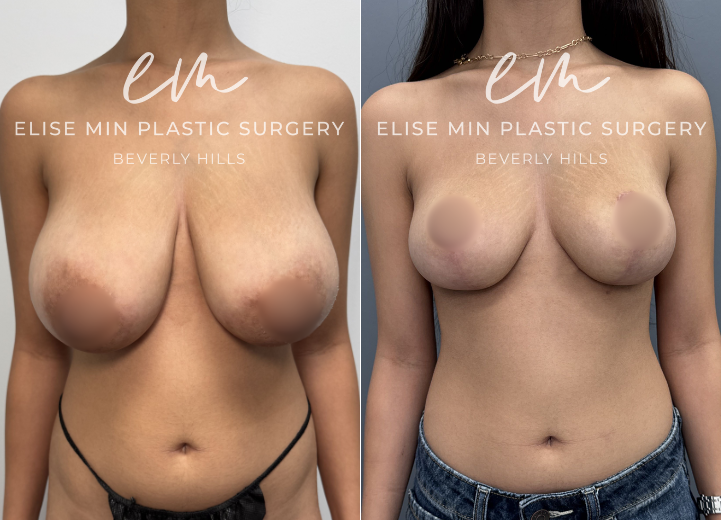 This 22-year-old woman felt that her 30DD breasts appeared overly sexualized and disproportionate to her frame, and she desired a lighter, smaller, more balanced silhouette. She underwent a modified vertical L-scar breast reduction with 309g removed from the right breast and 275g from the left. She is thrilled with her results and feels more comfortable in her clothing and body. 