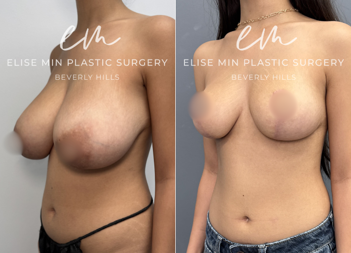 This 22-year-old woman felt that her 30DD breasts appeared overly sexualized and disproportionate to her frame, and she desired a lighter, smaller, more balanced silhouette. She underwent a modified vertical L-scar breast reduction with 309g removed from the right breast and 275g from the left. She is thrilled with her results and feels more comfortable in her clothing and body. 