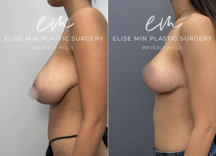 This 22-year-old woman felt that her 30DD breasts appeared overly sexualized and disproportionate to her frame, and she desired a lighter, smaller, more balanced silhouette. She underwent a modified vertical L-scar breast reduction with 309g removed from the right breast and 275g from the left. She is thrilled with her results and feels more comfortable in her clothing and body. 