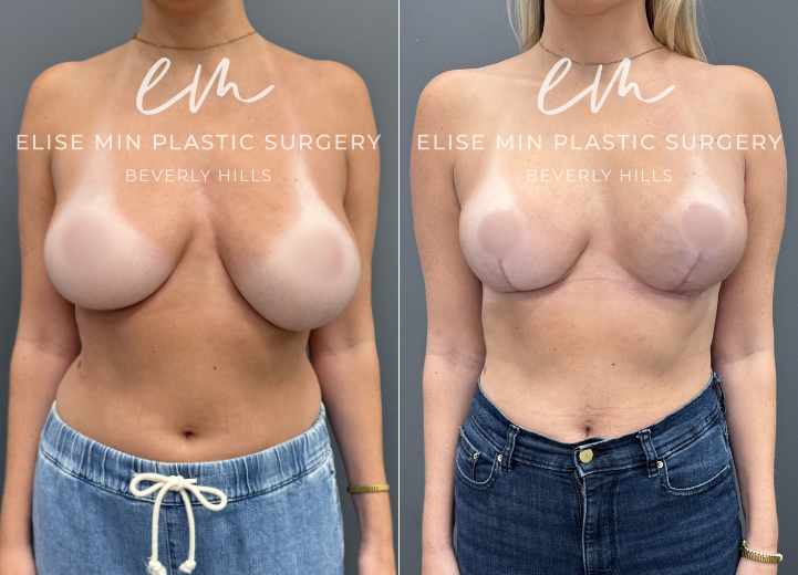 This 32-year-old woman felt that her 30DD breasts felt too heavy, and she desired a lighter, smaller, more balanced C cup breasts. She underwent a modified vertical L-scar breast reduction with 198g removed from the right breast and 300g from the left. She also elected for a synthetic absorbable mesh (TIGR mesh) for long-term soft tissue support. She is thrilled with her results and feels more comfortable in her clothing and body. 