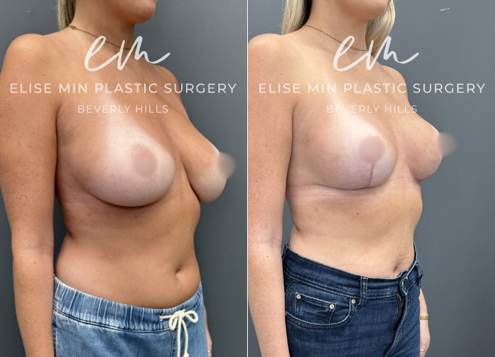This 32-year-old woman felt that her 30DD breasts felt too heavy, and she desired a lighter, smaller, more balanced C cup breasts. She underwent a modified vertical L-scar breast reduction with 198g removed from the right breast and 300g from the left. She also elected for a synthetic absorbable mesh (TIGR mesh) for long-term soft tissue support. She is thrilled with her results and feels more comfortable in her clothing and body. 