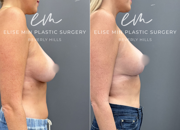 This 32-year-old woman felt that her 30DD breasts felt too heavy, and she desired a lighter, smaller, more balanced C cup breasts. She underwent a modified vertical L-scar breast reduction with 198g removed from the right breast and 300g from the left. She also elected for a synthetic absorbable mesh (TIGR mesh) for long-term soft tissue support. She is thrilled with her results and feels more comfortable in her clothing and body. 