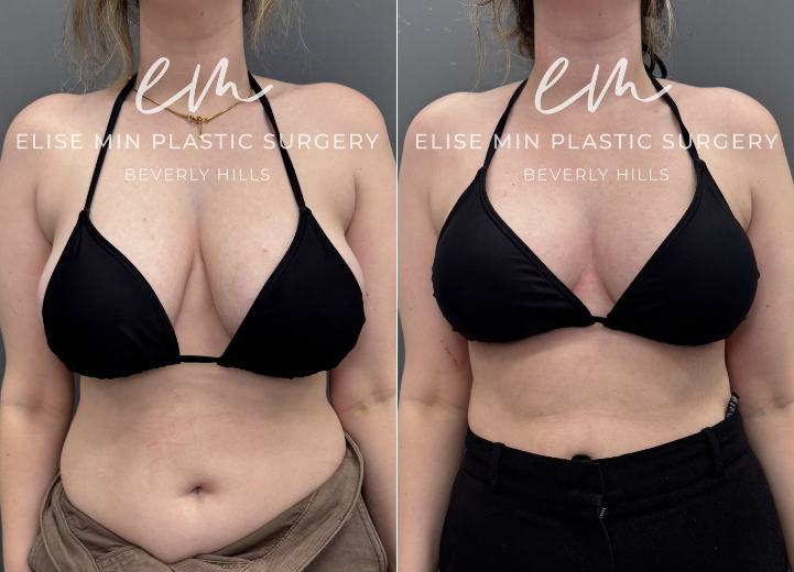 This 31-year-old patient felt her 32DD breasts were heavy and disproportionate to her frame, and she desired a lighter, more balanced C cup. She underwent a vertical breast reduction with 232g removed from the right breast and 278g from the left, along with liposuction of the bilateral lateral chest wall for improved contour. She shares that she feels like a new person—lighter, freer, and more aligned with herself.