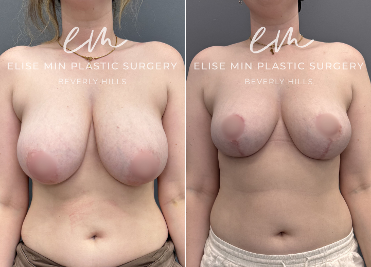 This 31-year-old patient felt her 32DD breasts were heavy and disproportionate to her frame, and she desired a lighter, more balanced C cup. She underwent a vertical breast reduction with 232g removed from the right breast and 278g from the left, along with liposuction of the bilateral lateral chest wall for improved contour. She shares that she feels like a new person—lighter, freer, and more aligned with herself.