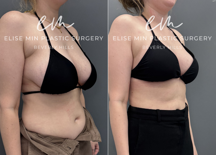 This 31-year-old patient felt her 32DD breasts were heavy and disproportionate to her frame, and she desired a lighter, more balanced C cup. She underwent a vertical breast reduction with 232g removed from the right breast and 278g from the left, along with liposuction of the bilateral lateral chest wall for improved contour. She shares that she feels like a new person—lighter, freer, and more aligned with herself.
