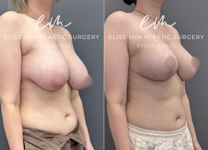 This 31-year-old patient felt her 32DD breasts were heavy and disproportionate to her frame, and she desired a lighter, more balanced C cup. She underwent a vertical breast reduction with 232g removed from the right breast and 278g from the left, along with liposuction of the bilateral lateral chest wall for improved contour. She shares that she feels like a new person—lighter, freer, and more aligned with herself.