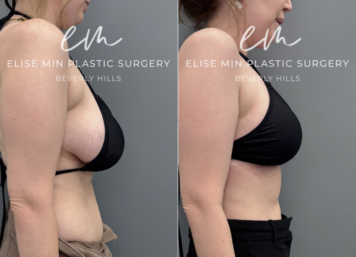 This 31-year-old patient felt her 32DD breasts were heavy and disproportionate to her frame, and she desired a lighter, more balanced C cup. She underwent a vertical breast reduction with 232g removed from the right breast and 278g from the left, along with liposuction of the bilateral lateral chest wall for improved contour. She shares that she feels like a new person—lighter, freer, and more aligned with herself.