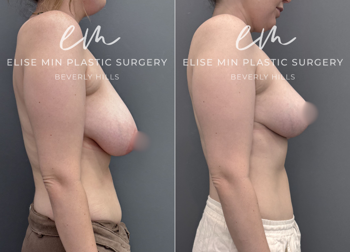 This 31-year-old patient felt her 32DD breasts were heavy and disproportionate to her frame, and she desired a lighter, more balanced C cup. She underwent a vertical breast reduction with 232g removed from the right breast and 278g from the left, along with liposuction of the bilateral lateral chest wall for improved contour. She shares that she feels like a new person—lighter, freer, and more aligned with herself.