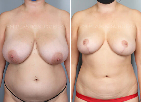 Breast Reduction Surgery Before & After
