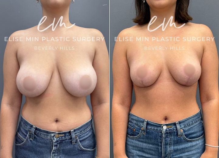 This 28-year-old woman presented with D to DD cup breasts and longstanding symptoms of heaviness and bra strap grooving that interfered with her daily activities. Although others reassured her that her breasts were not “too large,” she consistently felt uncomfortable and weighed down. She underwent a vertical scar breast reduction with 200g removed from each breast and elected placement of Galatea® synthetic absorbable mesh for added long-term soft tissue support. She is now a lifted C cup and reports a remarkable sense of lightness and relief.